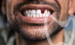 Don't ignore a missing tooth.